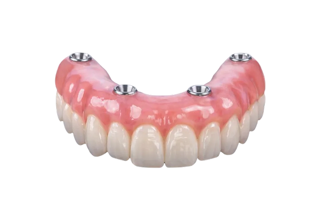 Fixed Full Arch Treatment