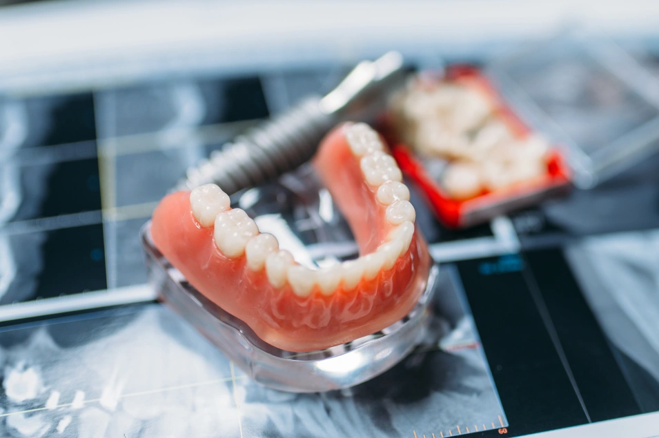 Implant Dentures