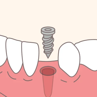 Placing the implant & closing the gum tissue