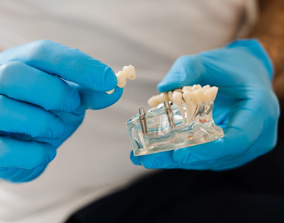 What Happens if You Skip Dental Implants 2