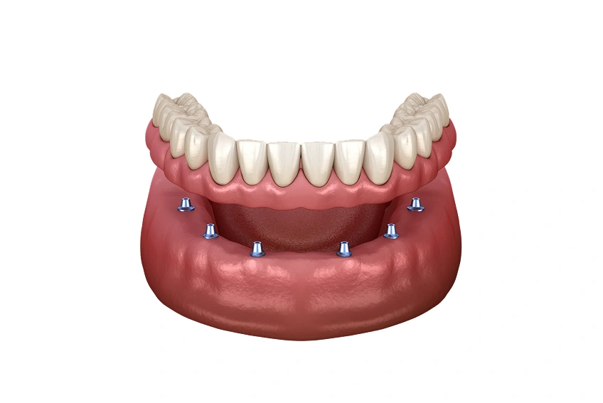 Implant dentures