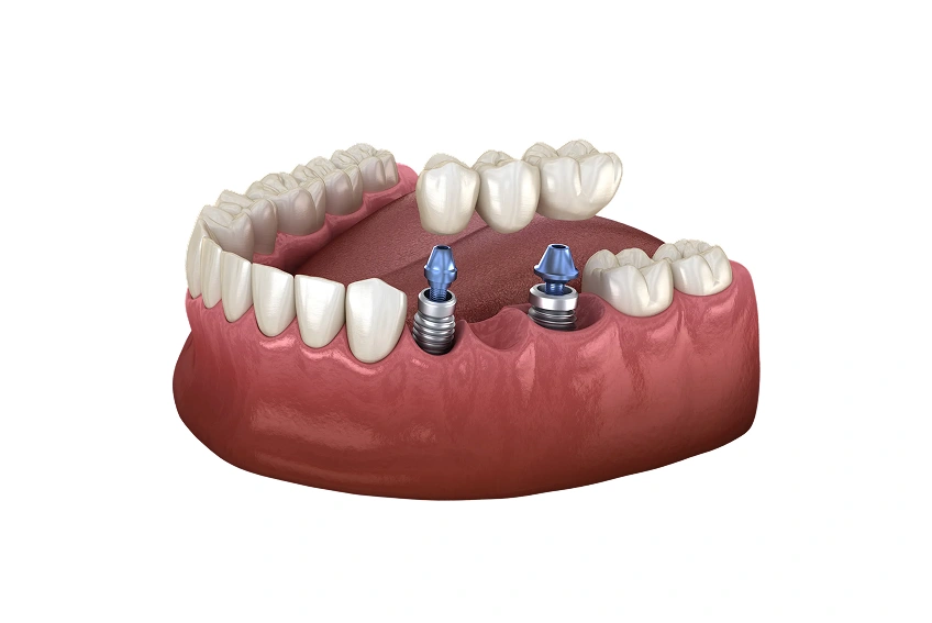 implant supported bridge