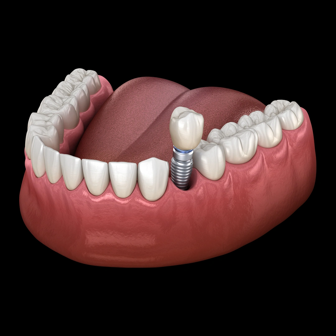 single-tooth-dental-implant-1