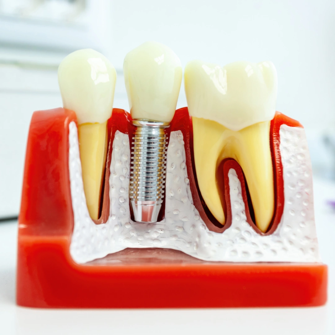single-tooth-dental-implant-2