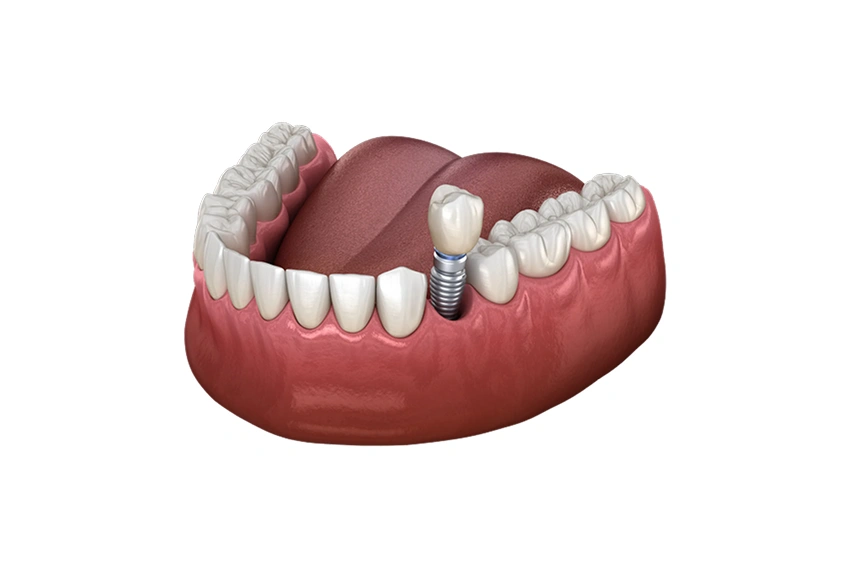 single tooth dental implant