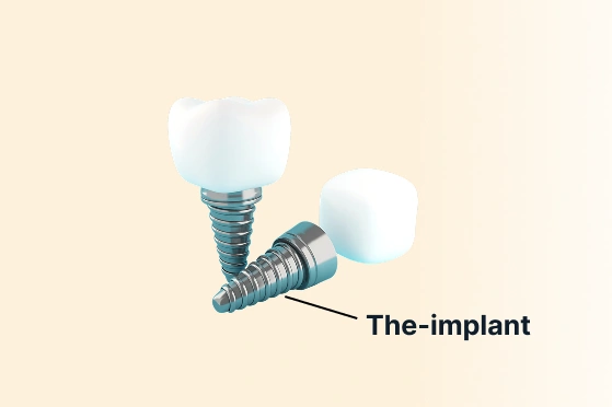 the implant