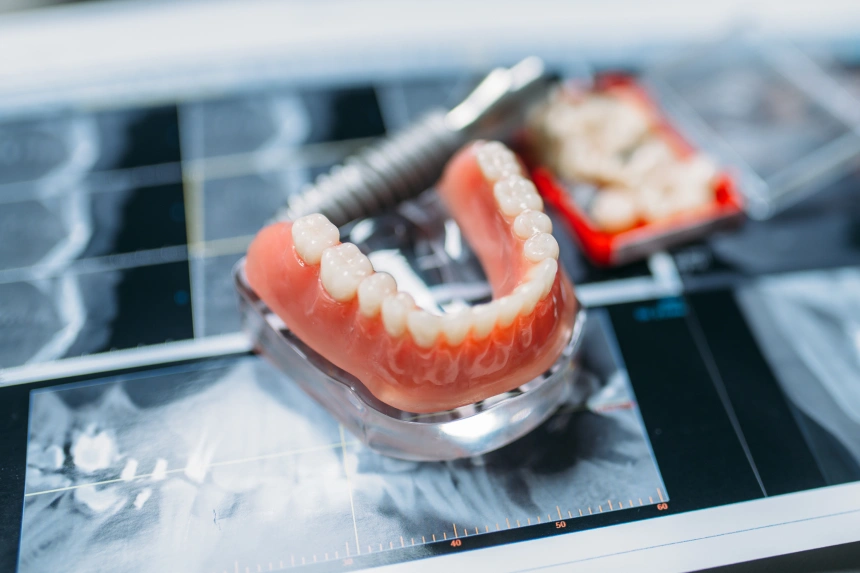 what are Dental Implants for the Full Upper Arch