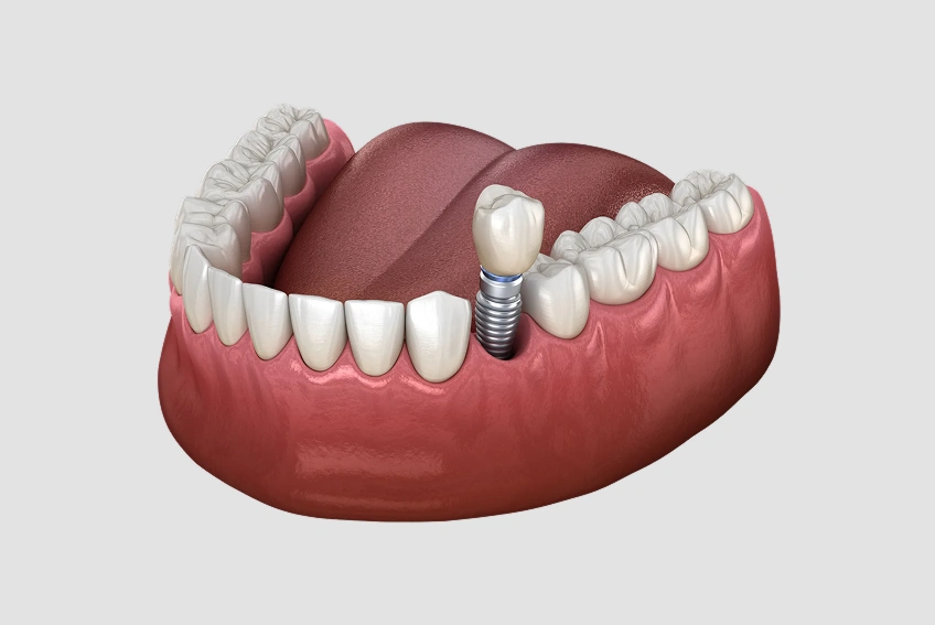 Single Tooth Dental Implant