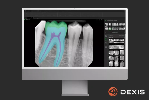 Dexis Digital Intraoral X-ray