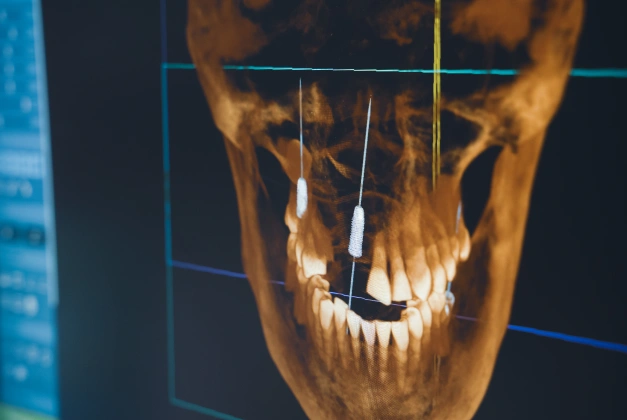 GuidedSMILE Dental Implant Planning