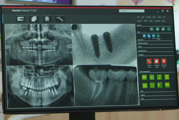 GuidedSMILE Surgical Implant Guides