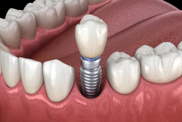 High Quality Dental Implants for Superior Results