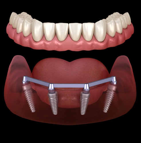 All-on-4 Dental Implants
