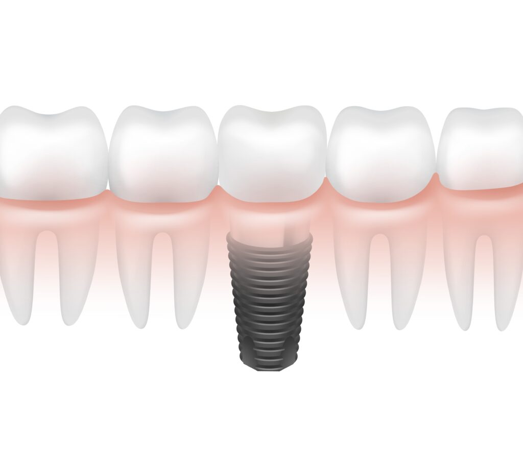 Dental Implants Mooresville